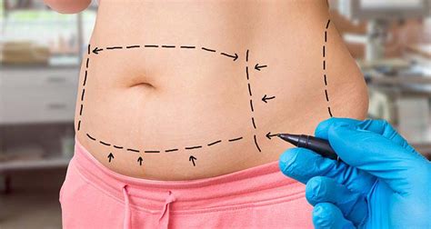 tijuana tummy tuck cost|Top 10 Clinics for Tummy Tuck in Tijuana